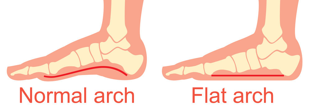 Foot Insoles for Flat Feet: What You Need to Know in 2026